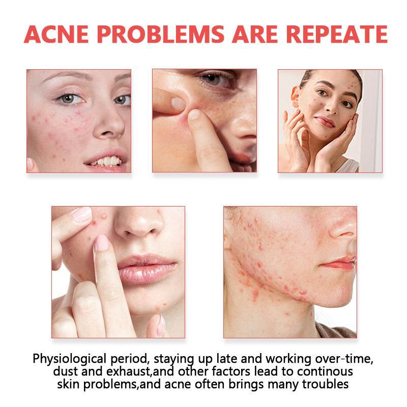 Patchs anti-acné invisibles en - Skincare Oil Control avis et prix